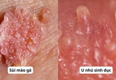 phan-biet-u-nhu-sinh-duc-voi-sui-mao-ga-tranh-nham-lan-nguy-hiem