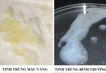 tinh-trung-co-mau-vang-xanh-bat-thuong-hon-70-la-do-benh-ly-nam-gioi-can-kham-ngay