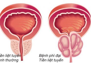phi-dai-tuyen-tien-liet-nguyen-nhan-trieu-chung-va-cach-dieu-tri-hieu-qua